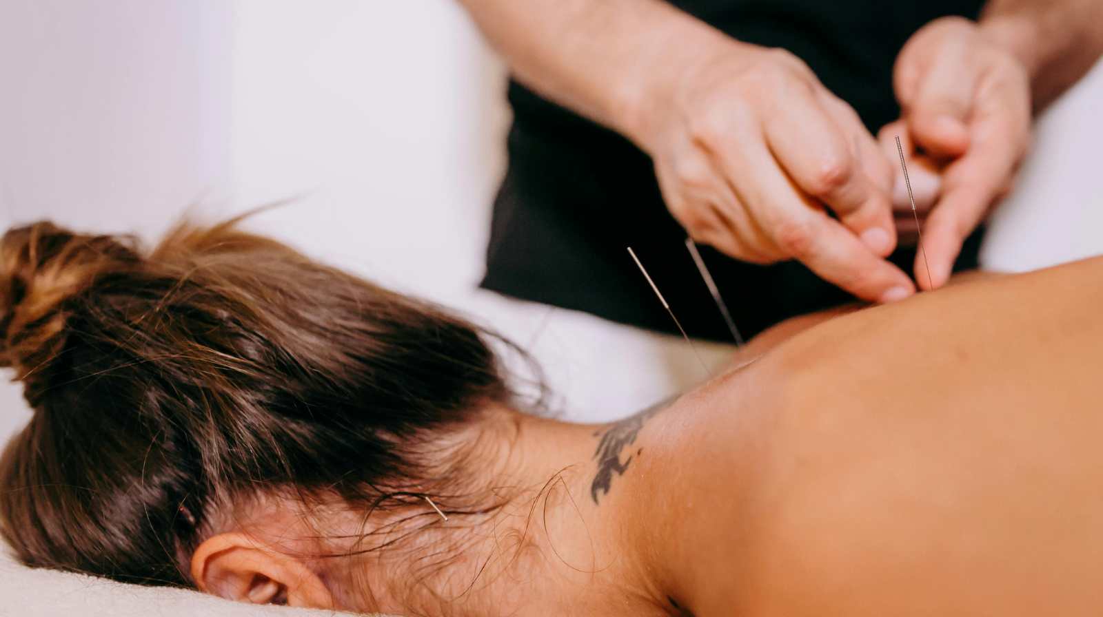 Dry Needling